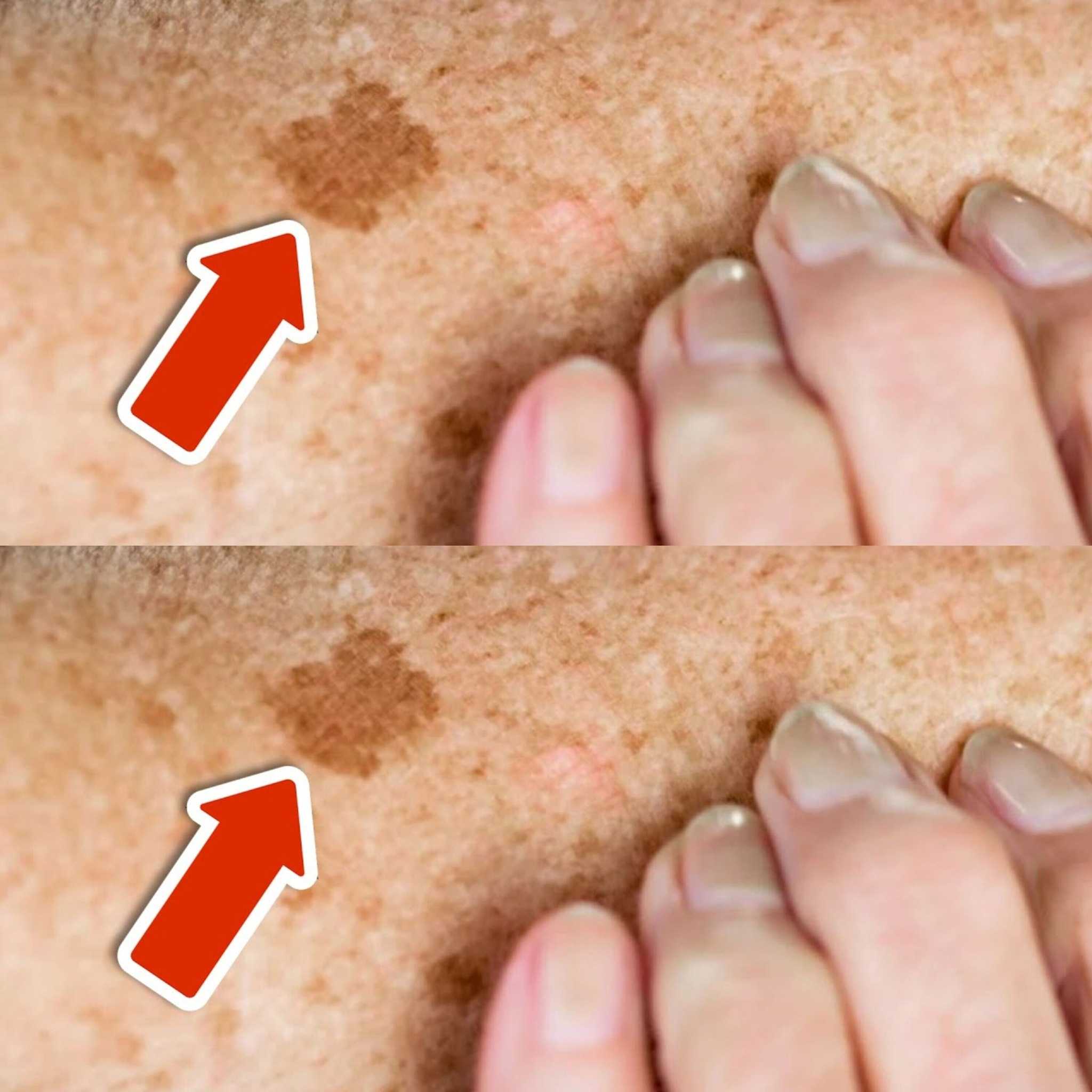 This Vitamin Removes Age Spots Permanently (ALWAYS Works)