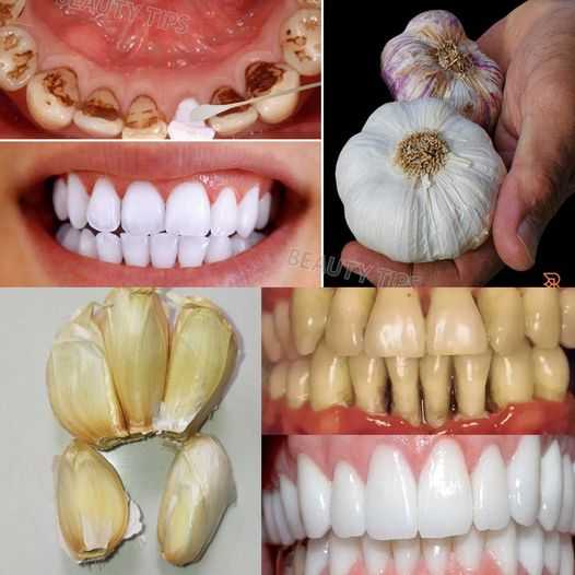 The Power of Garlic in Oral Health