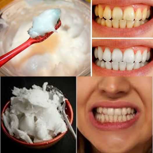 How to Naturally Whiten Your Teeth at Home in Just 3 Minutes Using Baking Soda and Coconut Oil