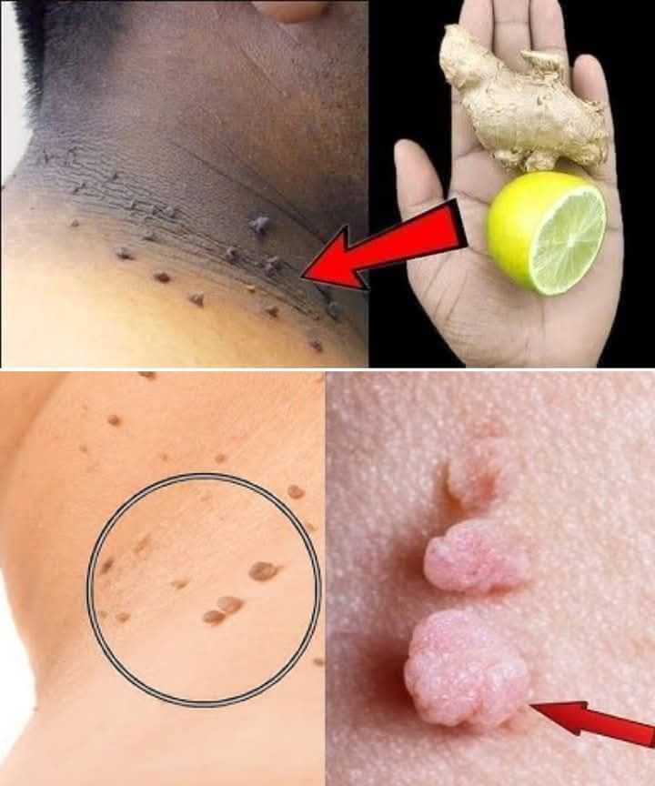 How to Remove Skin Tags at Home with Lemon and Ginger