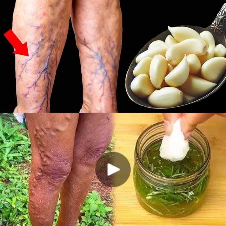 Unbelievable! Destroy Varicose Veins and Inflammation Naturally with Garlic