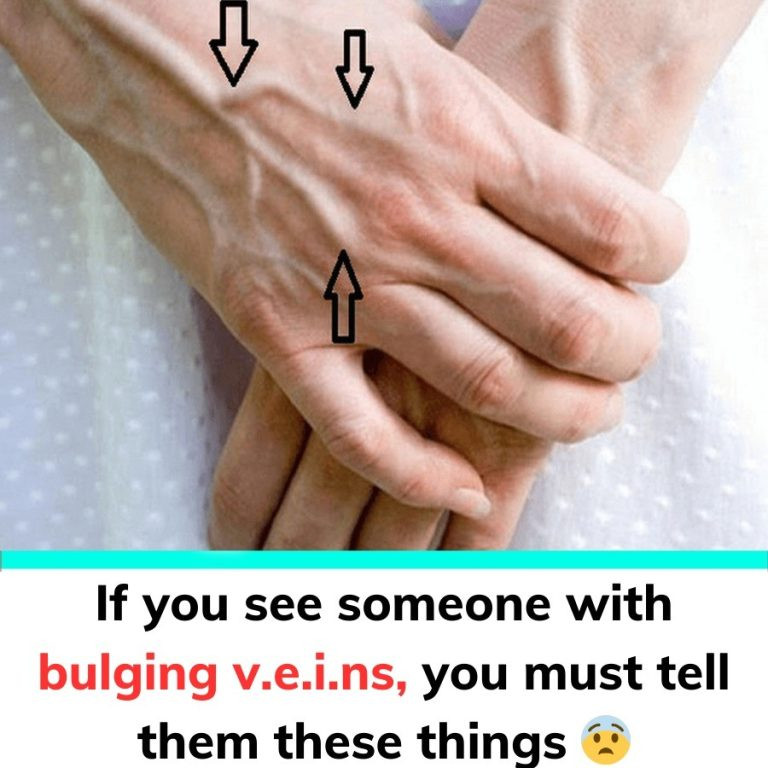 Someone with bulging v.e.i.ns