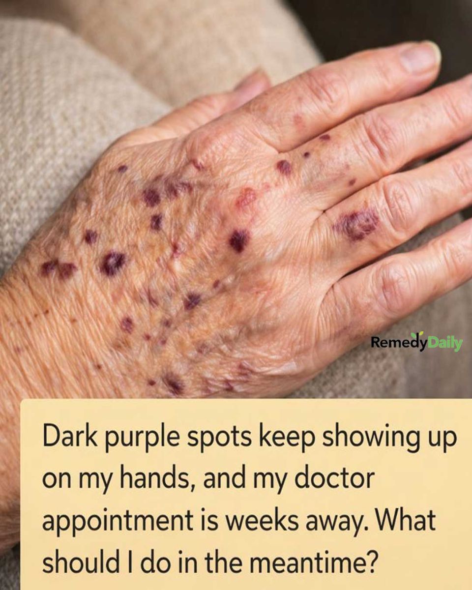 Dark purple spots keep showing up on my hands, and my doctor appointment is weeks away. What should I do in the meantime?