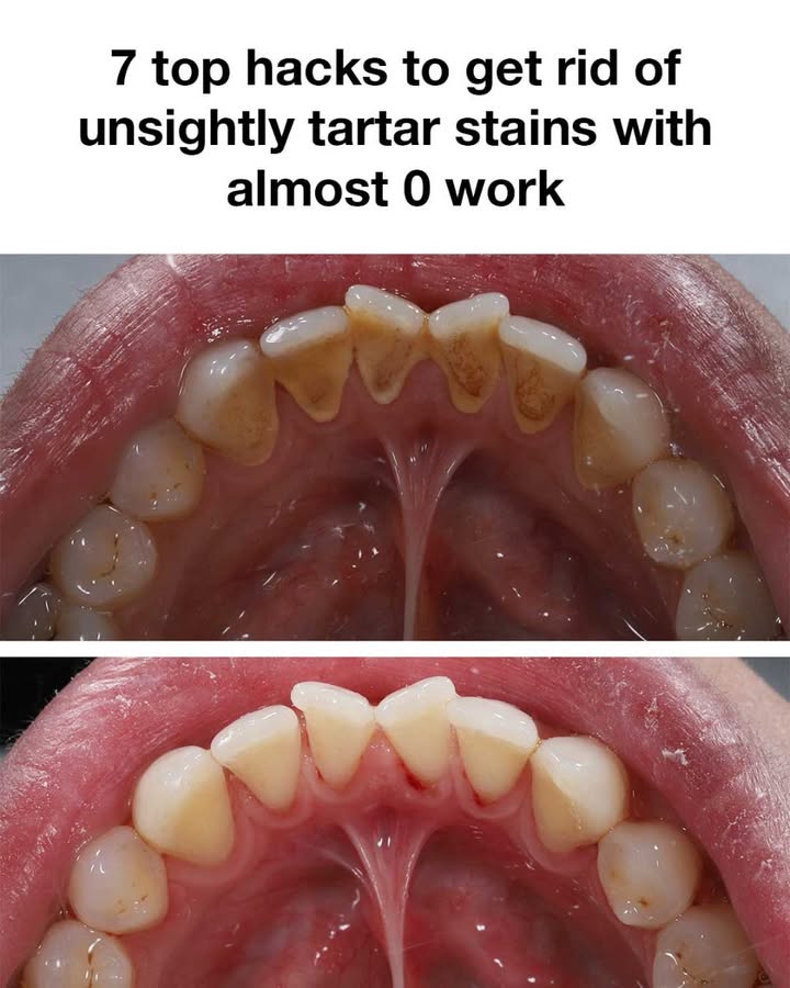 7 top hacks to get rid of unsightly tartar stains with almost 0 work