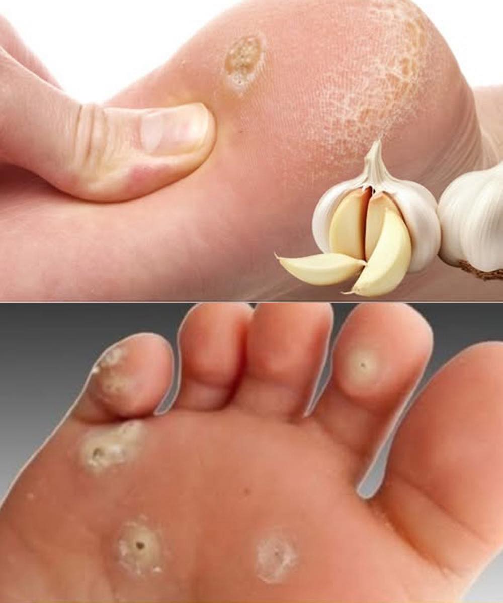 Eliminate Plantar Warts with These Natural Garlic Remedies