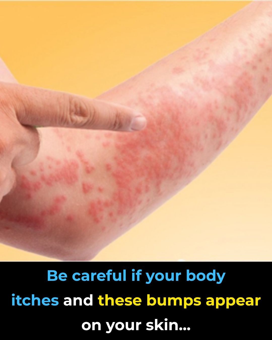 Surprising Causes Of Hives Revealed — What May Be Triggering Your Skin Reaction