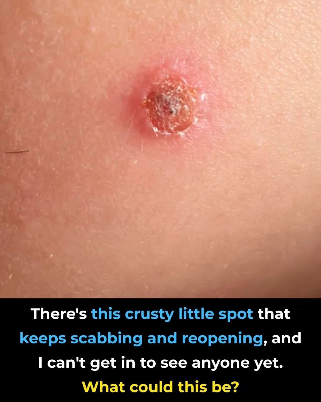 There’s this crusty little spot that keeps scabbing and reopening, and I can’t get in to see anyone yet. What could this be?