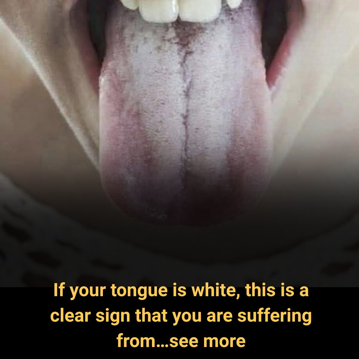 What a White Tongue May Be Telling You About Your Oral Health